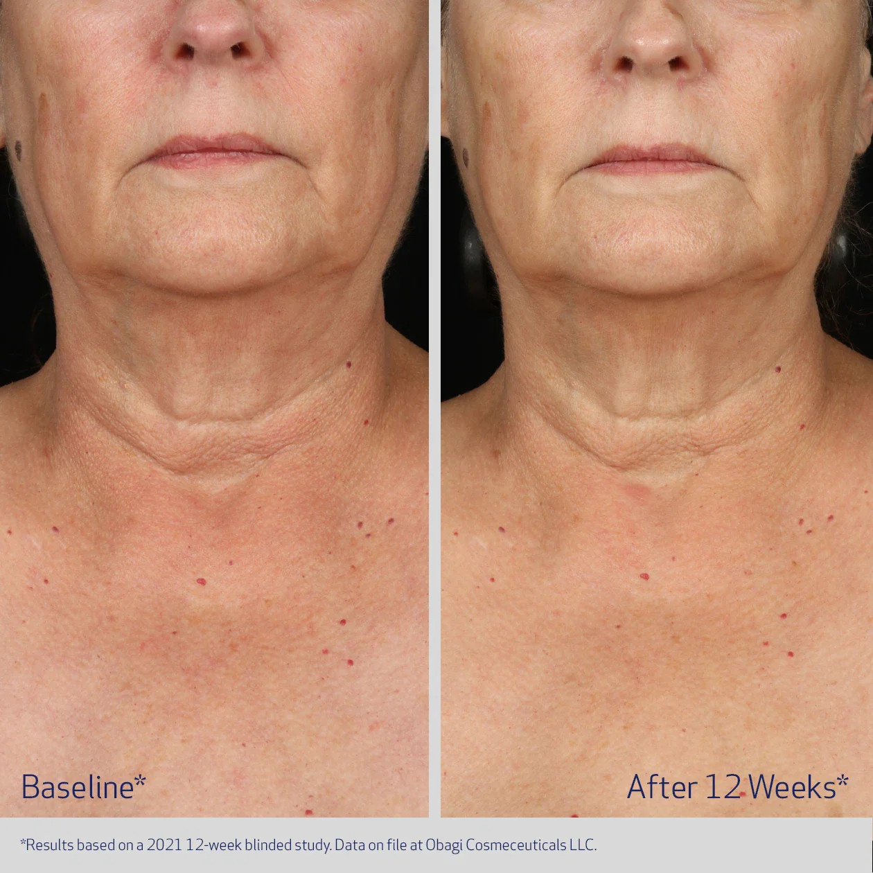 Омолаживающий гель-концентрат для шеи и зоны декольте / Obagi Elastiderm Neck and Decollete Concentr