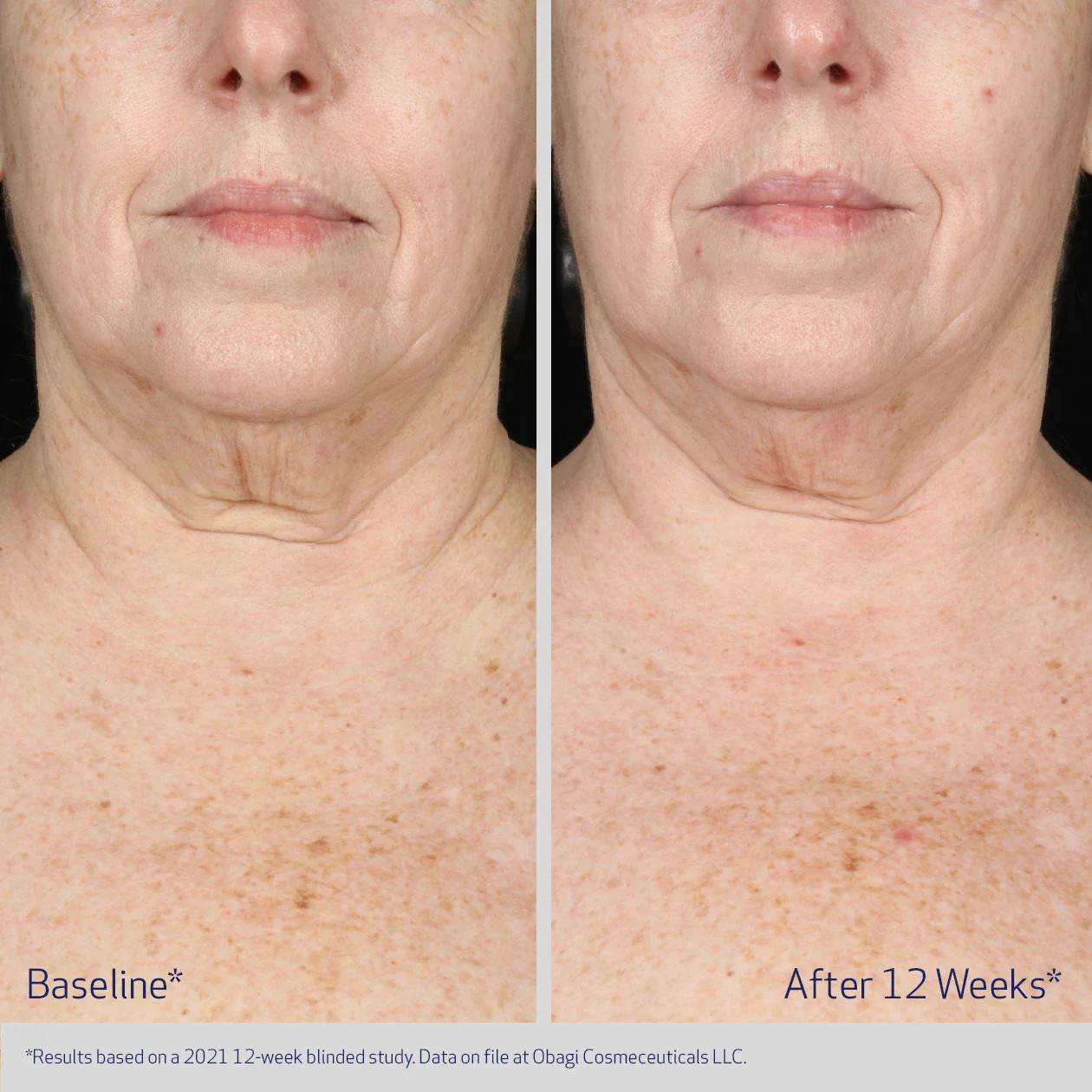 Омолаживающий гель-концентрат для шеи и зоны декольте / Obagi Elastiderm Neck and Decollete Concentr